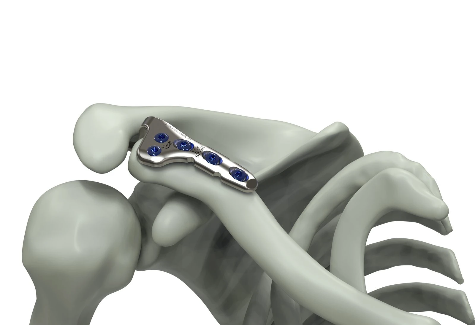 Clavicle Plate